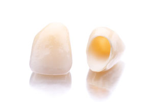 Porcelain Crowns