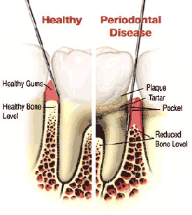 Periodontal Disease Diagram