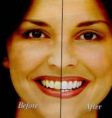 Teeth Whitening Before and After